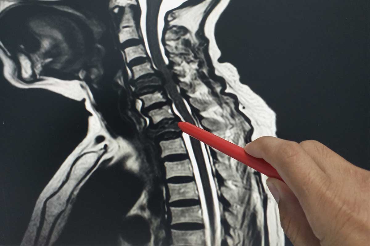 Close up of a doctor’s hand holding a red pen sharing examination results of the spine MRI.