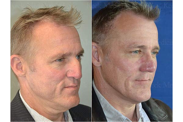 A before and after photo of a nose job done at Keck Medicine of USC.
