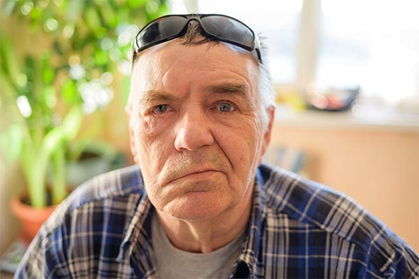 A man with Bell's Palsy looks into the camera.