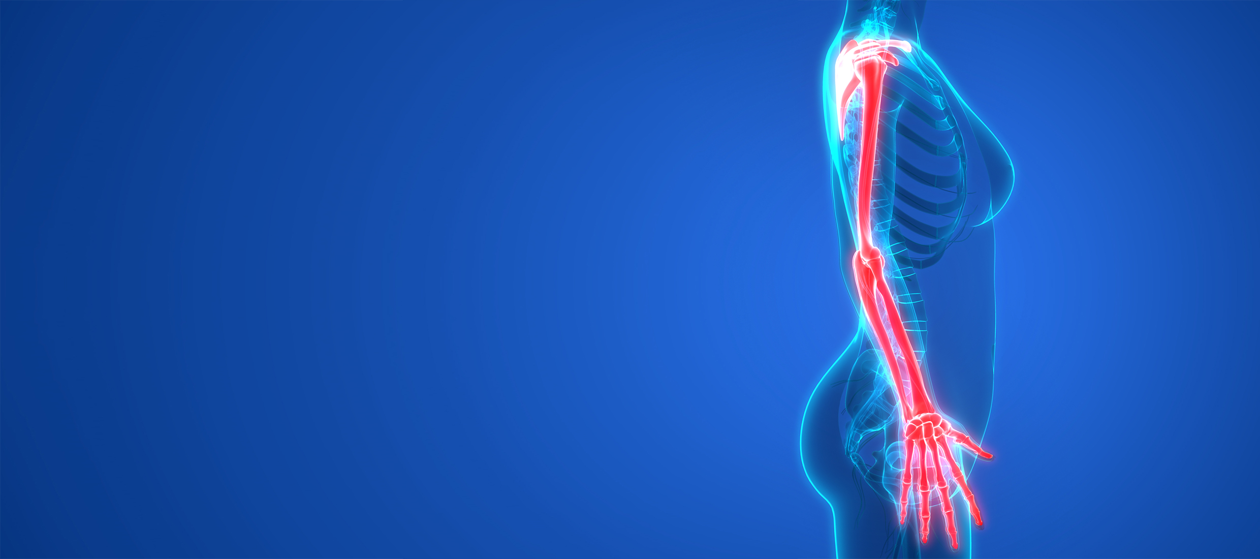 A 3D rendering of a female radiculopathy patient in blue and a red arm with arm pain is shown on a blue background