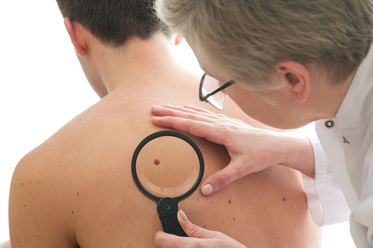 Doctor examining a mole on a patient's back with a magnifying glass