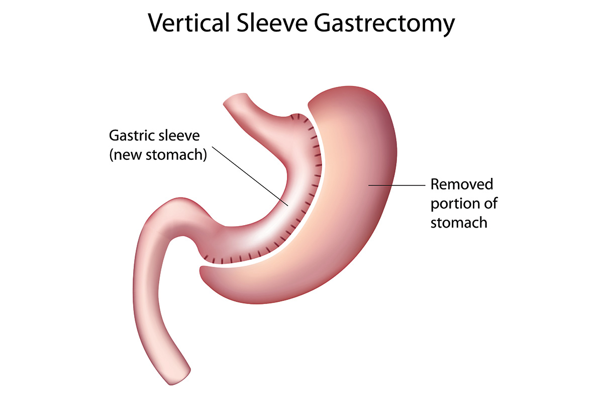 A drawing of a vertical sleeve gastrectomy shows the new stomach and the removed portion of the stomach