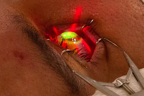 Close-up of ultraviolet light used to stabilize the cornea.