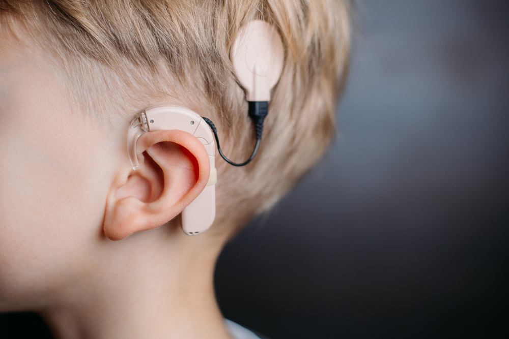 Cochlear Implants Key for Early Intervention Keck Medicine of USC