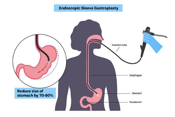 Diagram of an endoscopic sleeve gastroplasty.