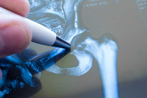 Doctor pointing at an X-ray of hip joint