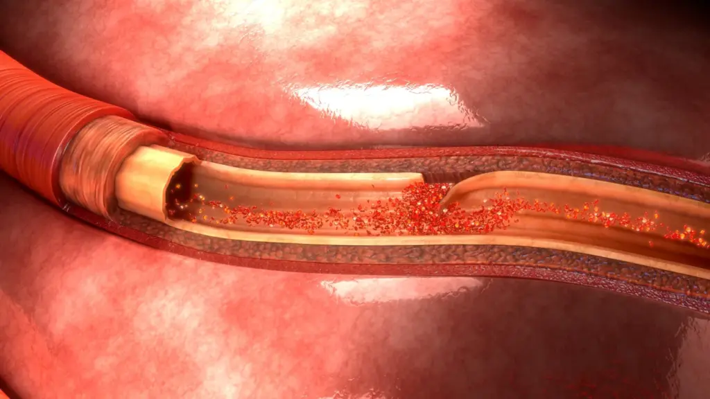 Surgeons Model Next-Generation Aortic Dissection Care