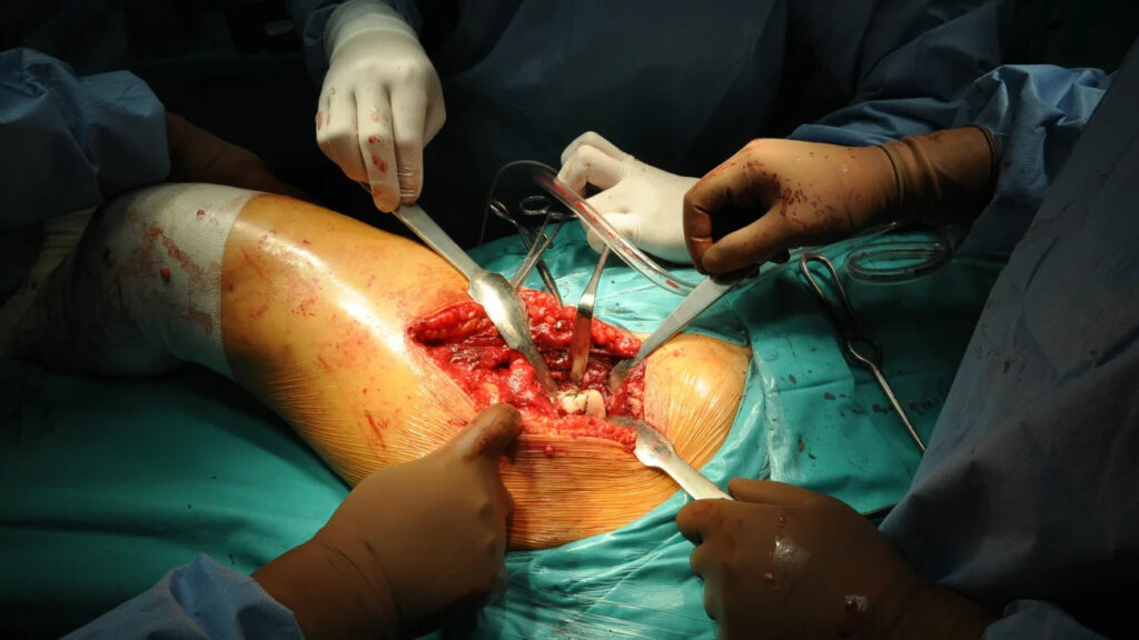Higher Blood Glucose Levels on Surgery Day Could Increase Infection Risk After Hip Replacement