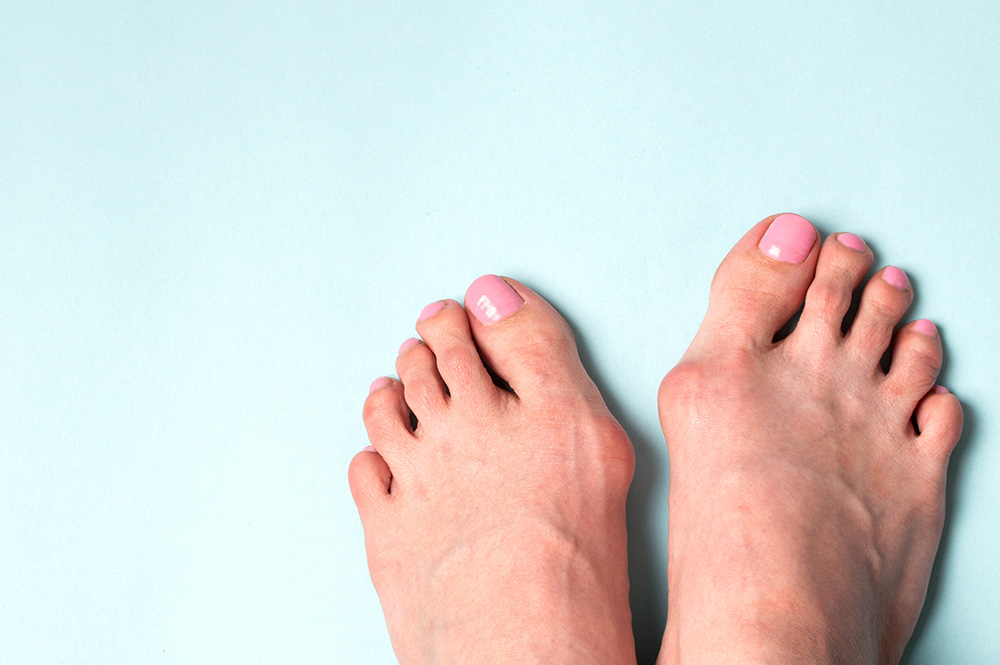 Women examines bunions on feet.