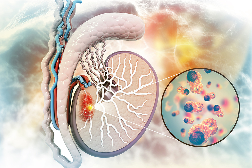 Illustration of a testicle with testicular cancer tumor.