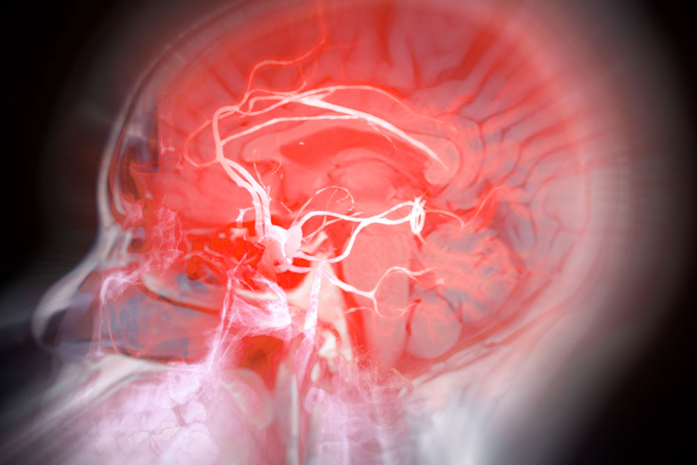 Can This Device Help Neurosurgeons Better Treat Normal Pressure Hydrocephalus — and More?