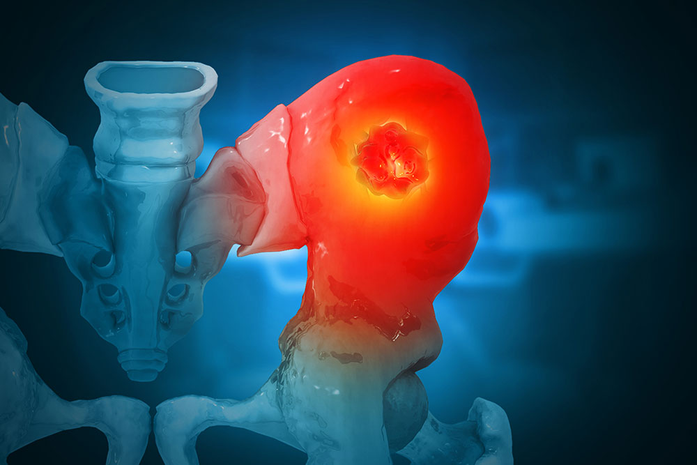 Bone Metastasis Happens in Up to 50% of Advanced Cancer Cases. Is Treatment Improving?