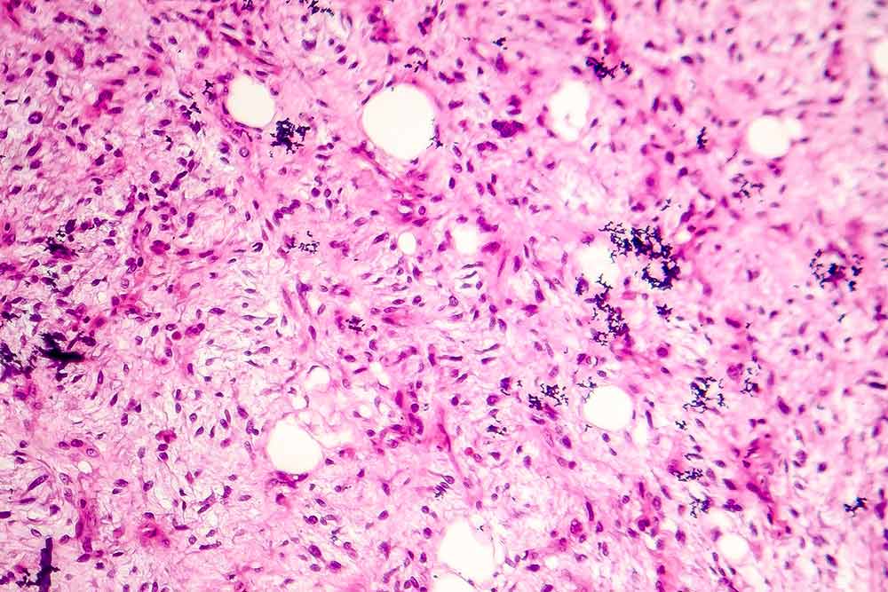 Personalized Medicine Shows Promise in Improving Sarcoma Care