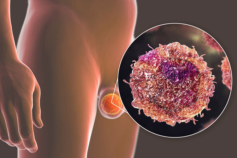 Can Early Metastatic Testicular Cancer Be Cured with Surgery Alone?