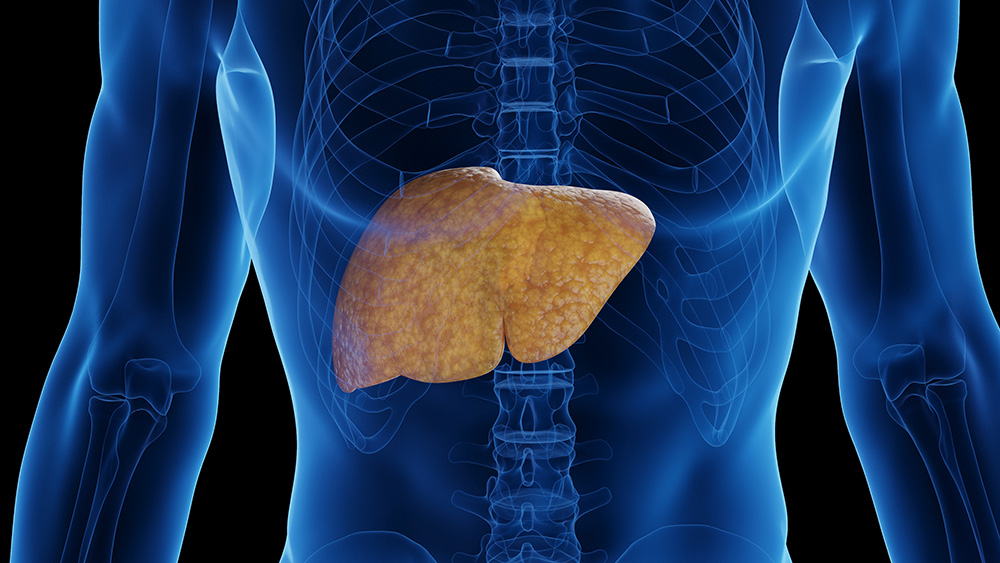 How Rising Rates of MASLD/MASH Are Impacting Liver Transplant Demand