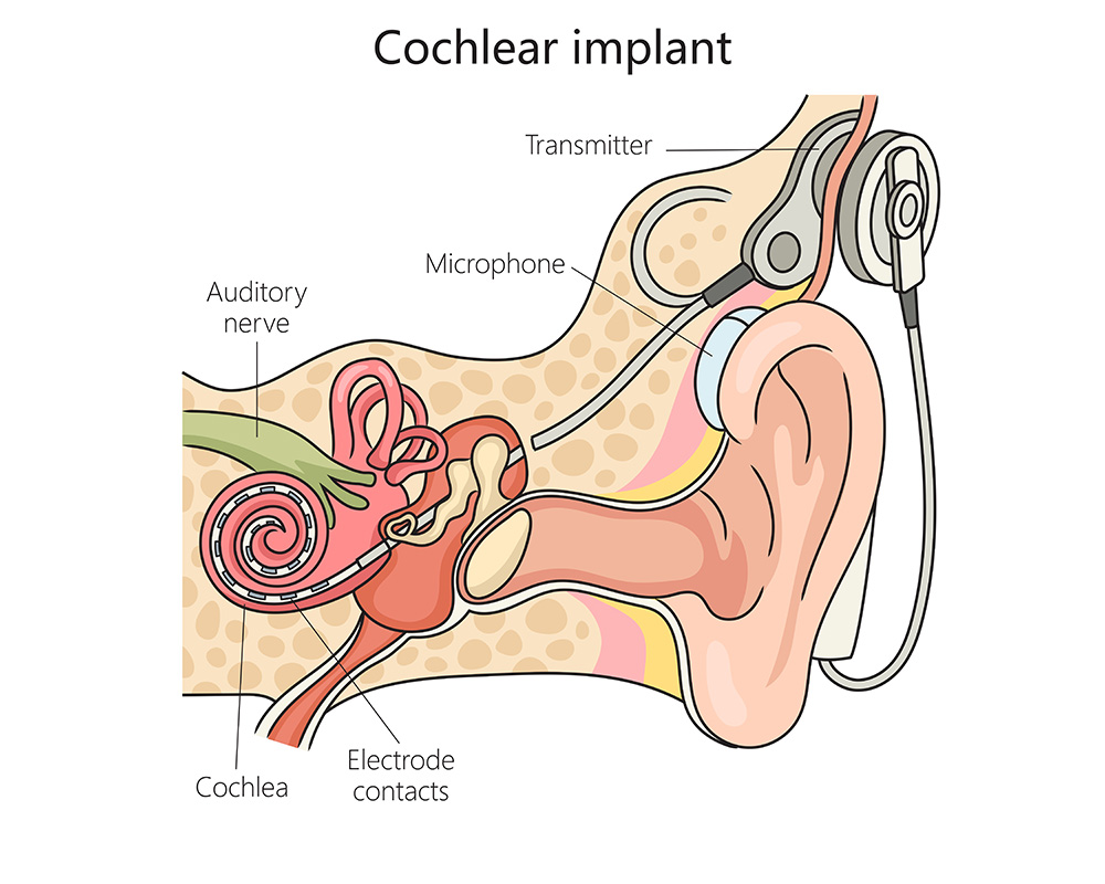 Robotically Assisted Insertion Improves Cochlear Implant Outcomes
