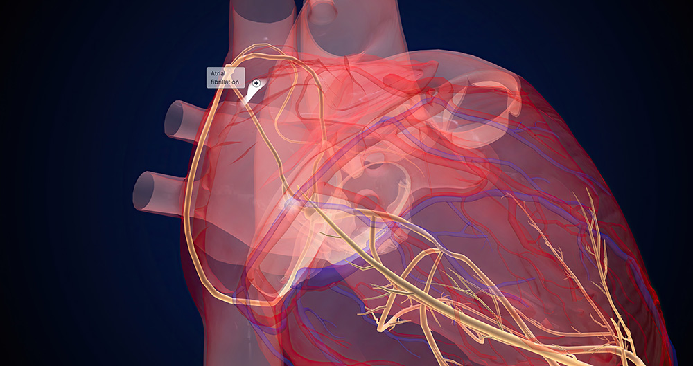 Minimally Invasive TT Maze Surgery Advances AFib Treatment