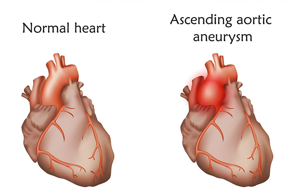Aortic Aneurysm Risk: When Is the Right Time to Refer to a Specialist?