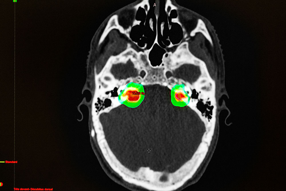 Precision Over Aggression: Evolving Strategies for Skull Base Tumor Treatment